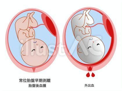 胎盤剝離方式|胎盤早期剝離